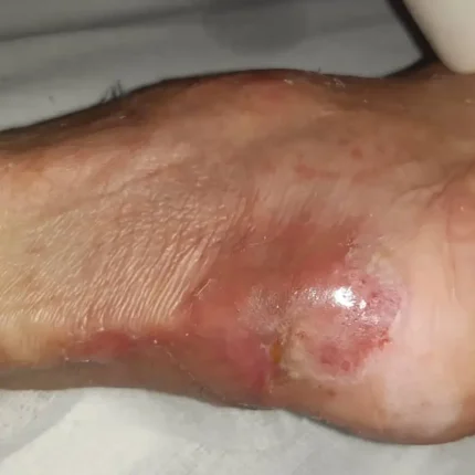 درمان زخم فشاری (بستر)