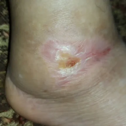 درمان زخم نوروایسکمیک